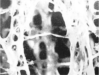 골다공증 환자의 뼈